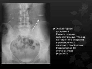 Гидронефроз 3 степени левой почки лечение