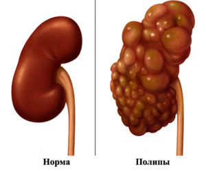 Полип почки причины и лечение