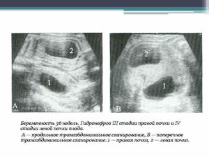 Увеличение правой почки у плода