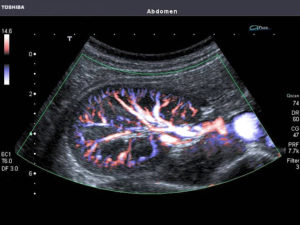 Доплерографическое исследование сосудов почек