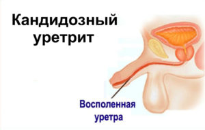 Грибковый уретрит у мужчин симптомы лечение