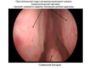 Отек отверстия мочеиспускательного канала