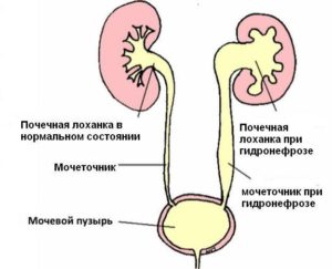 От чего увеличивается лоханка в почках