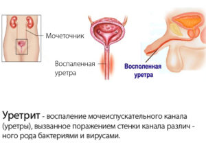 Симптомы бактериального уретрита у мужчин