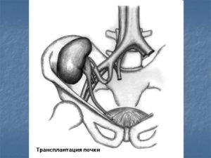 Где делают разрез при пересадке почки