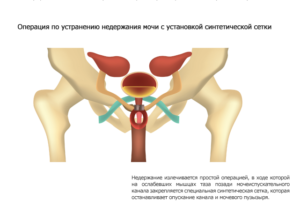 Установка сетки при недержании мочи у женщин