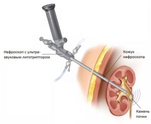 Удаление камней в почках в омске