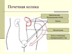 Мочекаменная болезнь почечная колика слева