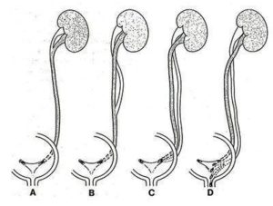 Удвоение почек и мочеточников