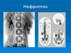 Нефроптоз классификация клиника диагностика лечение