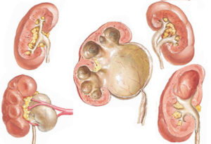 Каликопиелоэктазия левой почки что это такое лечение