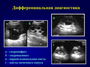 Чем отличается гидрокаликоз от гидронефроза