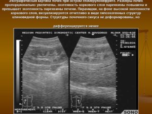 Эхогенность паренхимы почки