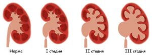 Умеренная дилатация лоханки почки что это