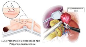 Последствия удаления правого надпочечника