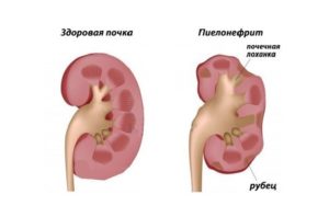 Беременность у ребенка увеличены почки