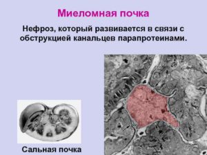 Миеломная болезнь почек