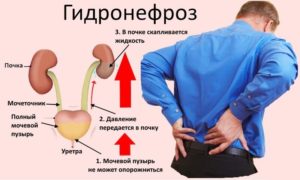 Гидронефроз почек лечение в москве