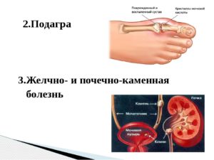 Мочекаменная болезнь и подагра