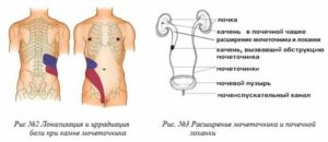 Боли в почке справа лечение