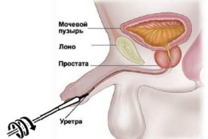 Как берут мазок у мужчин на инфекции