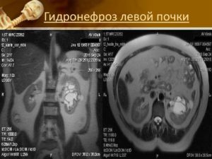 Гидронефроз 3 степени левой почки лечение