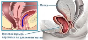 Опущение мочевого пузыря симптомы