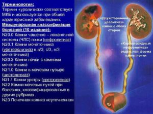 Мкб 10 мочекаменная болезнь камень мочеточника