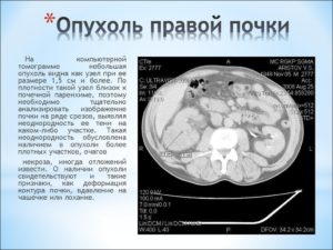 Что значит новообразование на почке