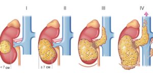 Рак почки четвертая стадия