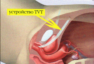 Установка сетки при недержании мочи у женщин