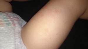 Аллергия на мочу у ребенка