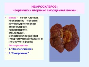 Сморщенные почки симптомы лечение прогноз