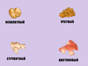 Состав камней в почках по цвету