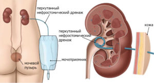 Стенд при почках