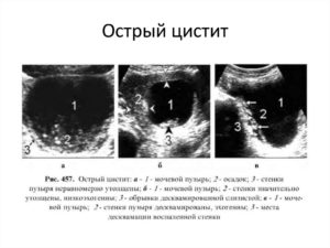 Узи мочевого пузыря цистит