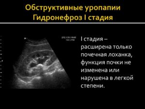 Гидронефроз почки 1 степени что это