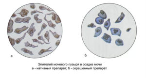 Эпителий плоский в моче 2 4