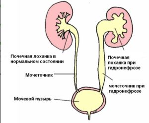 Увеличение лоханки почки у детей