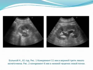 Конкременты чашечек левой почки