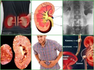 Нефропатия почек симптомы лечение