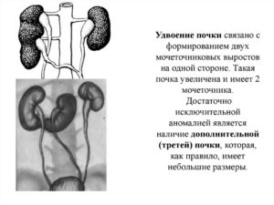 Удвоение почки у взрослого что это такое