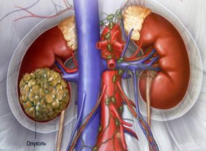 Удаление почки при раке как называется