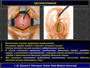 У кого нет мочевого пузыря