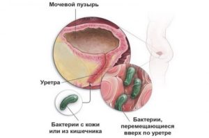 Инфекции мочевых путей у женщин