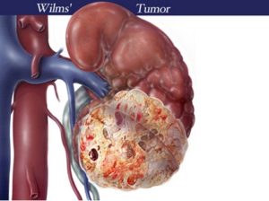 Опухоль вильмса почек