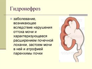 Левосторонний гидронефроз лечение