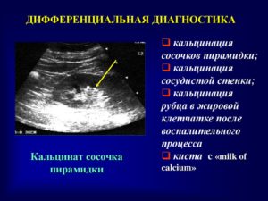 Кальцинат паренхимы почек