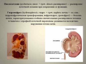 Пиелоэктазия правой почки у взрослого