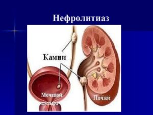 Нефролитиаз обеих почек